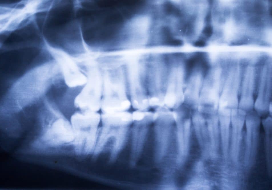 Wisdom-Teeth-Removal-Washington DC-Alexandria-Virginia